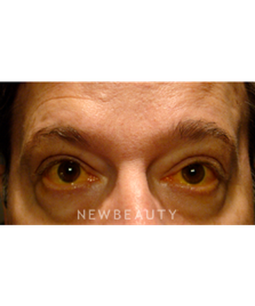dr-baljeet-purewal-lower-blepharoplasty-b
