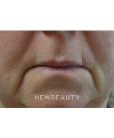dr-baljeet-purewal-liquid-facelift-b