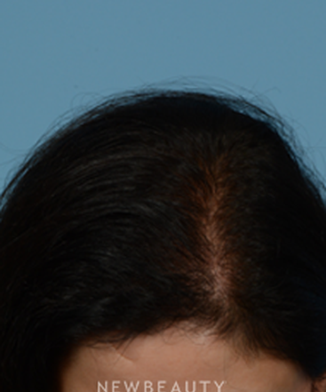 dr-jeffrey-wise-hair-loss-treatment-b