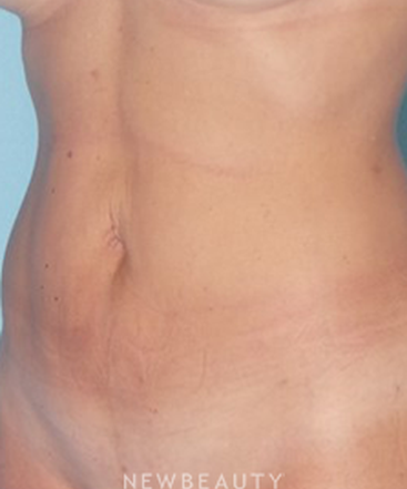 dr-sean-simon-smartlipo-b