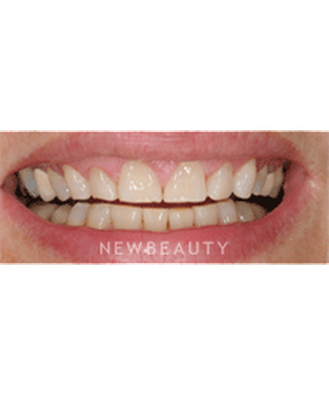 dr-ronald-goldstein-crowns-gum-countouring-veneers-b