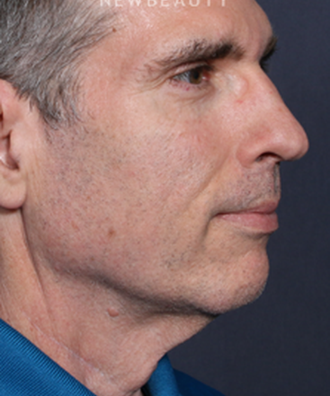 ljcsc-dr-brahme-facelift-b