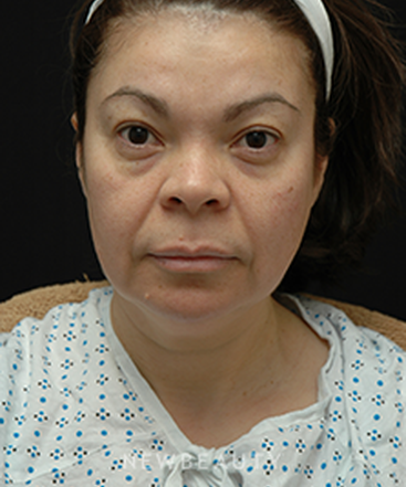 dr-jeffrey-b-wise-eyelift-facelift-necklift-b
