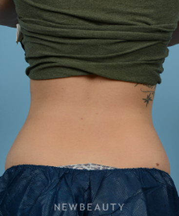 dr-jeffrey-wise-coolsculpting-b
