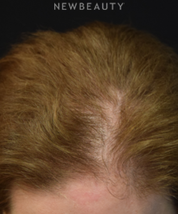 dr-jeffrey-wise-hair-loss-treatment-b