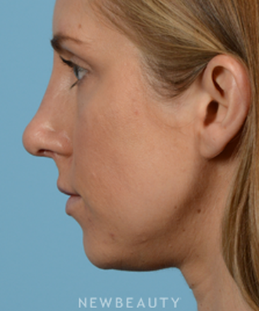 dr-jeffrey-wise-rhinoplasty-b