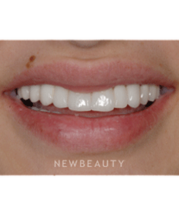 dr-ronald-goldstein-smile-makeover-b