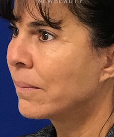 dr-dilip-madnani-facelift-necklift-b