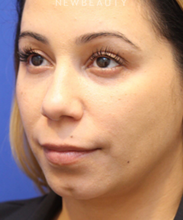 dr-jennifer-levine-liquid-facelift-b
