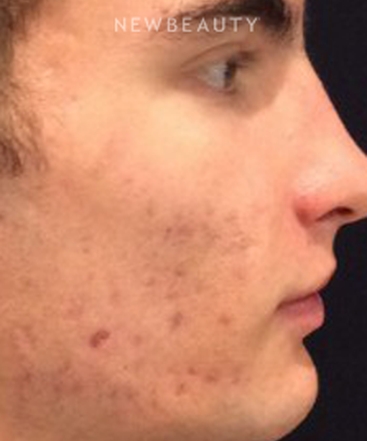 dr-kim-nichols-acne-treatment-b