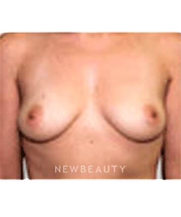 dr-sanjay-grover-breast-augmentation-b
