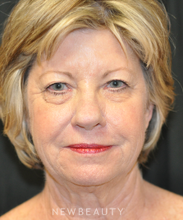 dr-andrew-smith-facelift-eyelift-necklift-b