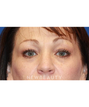 dr-dilip-madnani-upper-blepharoplasty-b