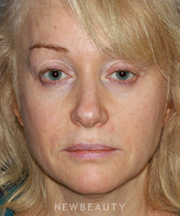 dr-konstantin-vasyukevich-facelift-b