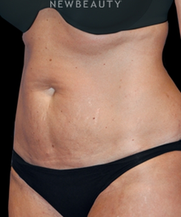dr-bryan-w-gawley-tummy-tuck-with-lipo-b