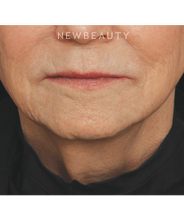 drs-jennifer-segal-scott-smith-injectables-fillers-b