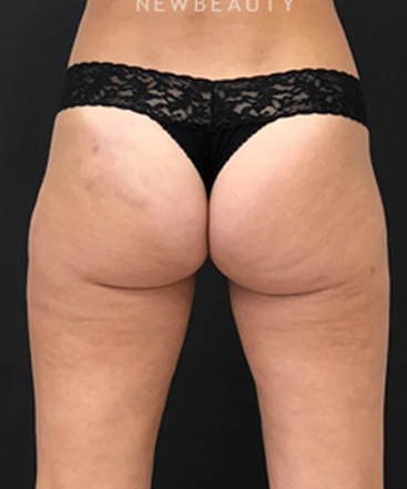 dr-janet-allenby-emsculpt-b
