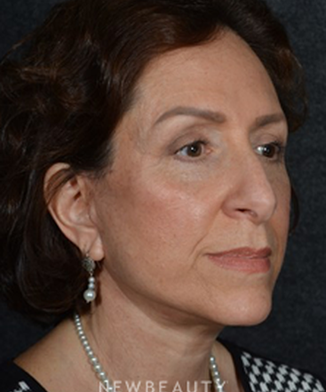 dr-ryan-chastant-facelift-b