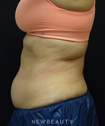 dr-jeffrey-b-wise-coolsculpting-b