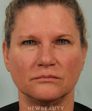 dr-kenneth-beer-liquid-facelift-b