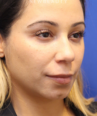 dr-jennifer-levine-liquid-facelift-b