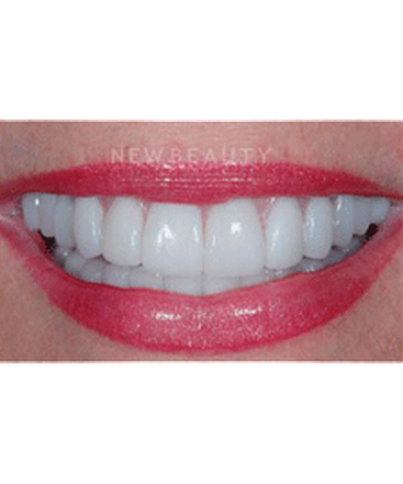 dr-guy-lewis-veneers-b
