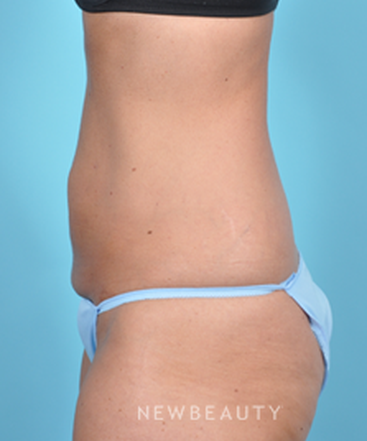dr-bradley-bengtson-coolsculpting-b