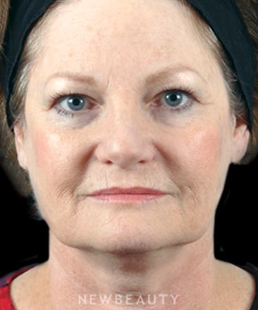 dr-bradley-bengtson-facial-rejuvenation-b