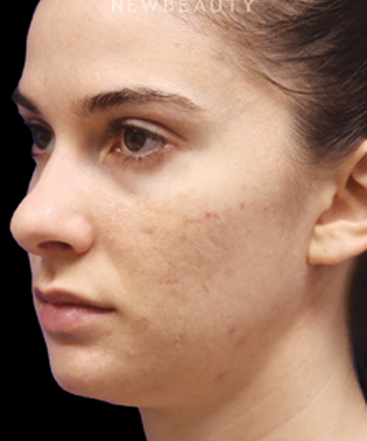 dr-jennifer-levine-rhinoplasty-b