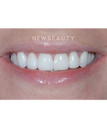 dr-guy-m-lewis-smile-makeover-b