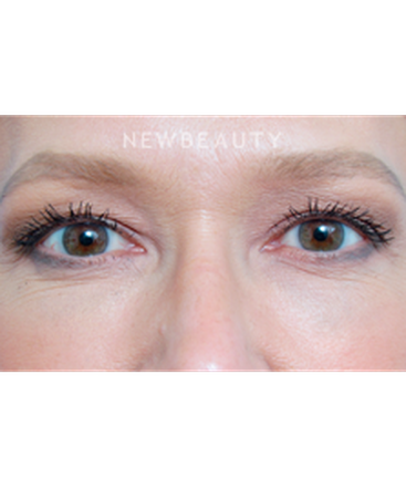 dr-raymond-douglas-under-eye-filler-b