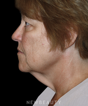 dr-brent-smith-eyelift-facelift-b