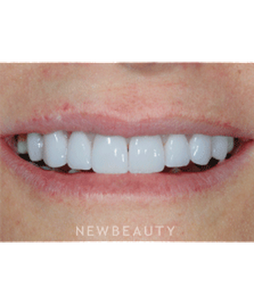 dr-guy-lewis-veneers-gum-lift-b