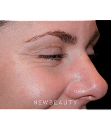 dr-marina-peredo-botox-b