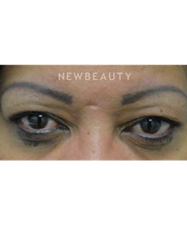 dr-baljeet-k-purewal-upper-blepharoplasty-b