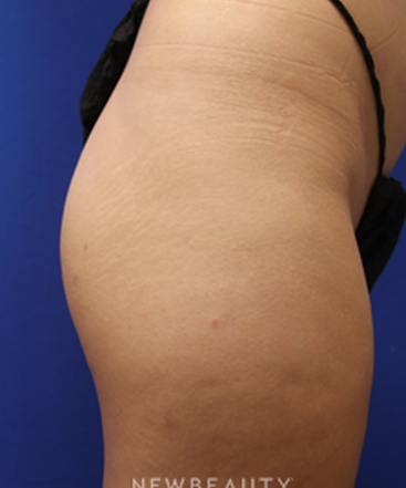 dr-jennifer-levine-sculptra-b