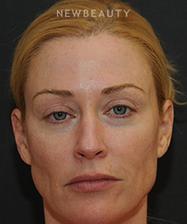 dr-janet-allenby-injectables-fillers-b