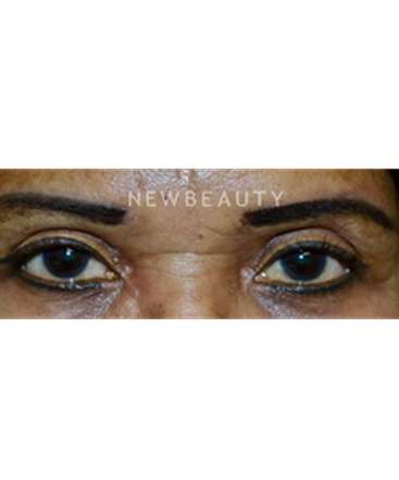 dr-baljeet-k-purewal-blepharoplasty-b
