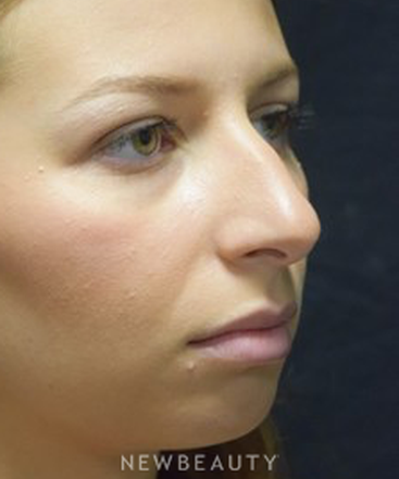 dr-jeffrey-b-wise-rhinoplasty-b