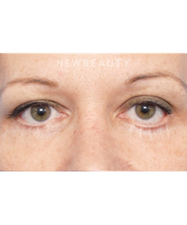 dr-raymond-douglas-lower-blepharoplasty-b