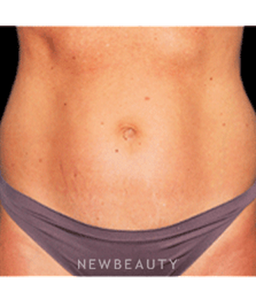 dr-bradley-bengtson-liposuction-b