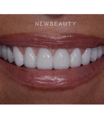 dr-guy-lewis-crowns-veneers-b