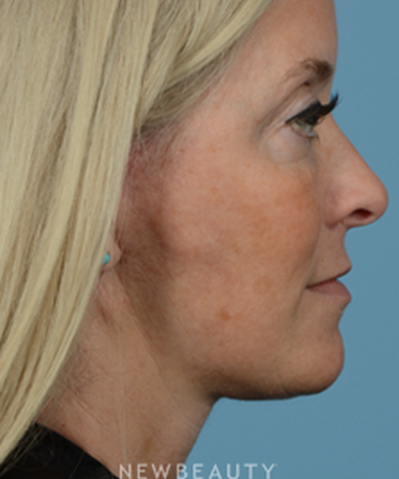 dr-jeffrey-wise-lower-facelift-b