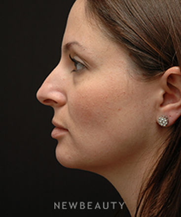 dr-jeffrey-b-wise-rhinoplasty-b