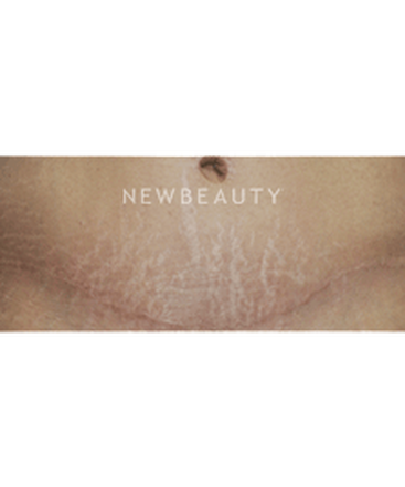 dr-kenneth-beer-fraxel-stretchmarks-b