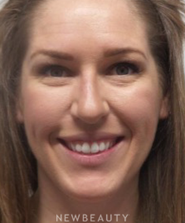 dr-marina-peredo-botox-b