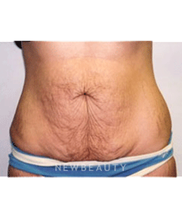 dr-sanjay-grover-tummy-tuck-b