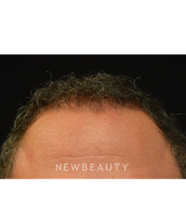 dr-jeffrey-b-wise-hair-transplant-b