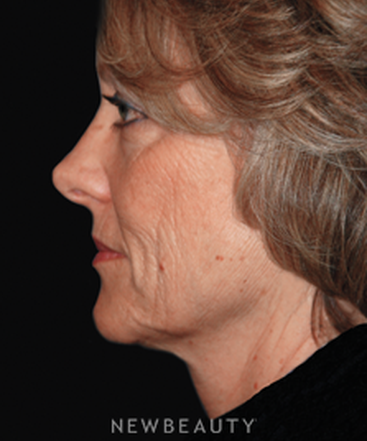 dr-brent-smith-combined-procedures-b