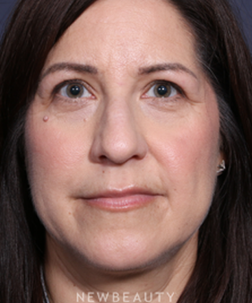 la-jolla-cosmetic-surgery-rhinoplasty-b